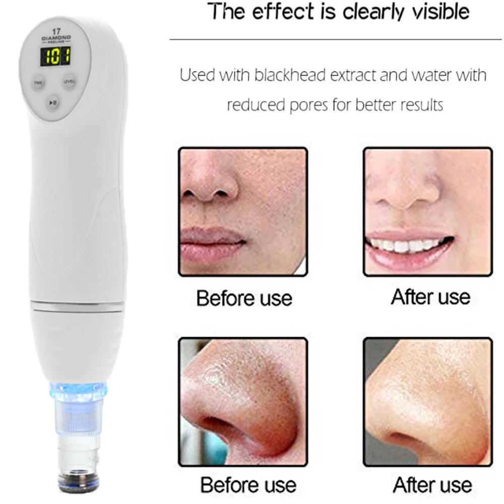 DermDelhi-Machine de peeling de la peau sous vide pour le visage, points noirs, élimination de l'acn
