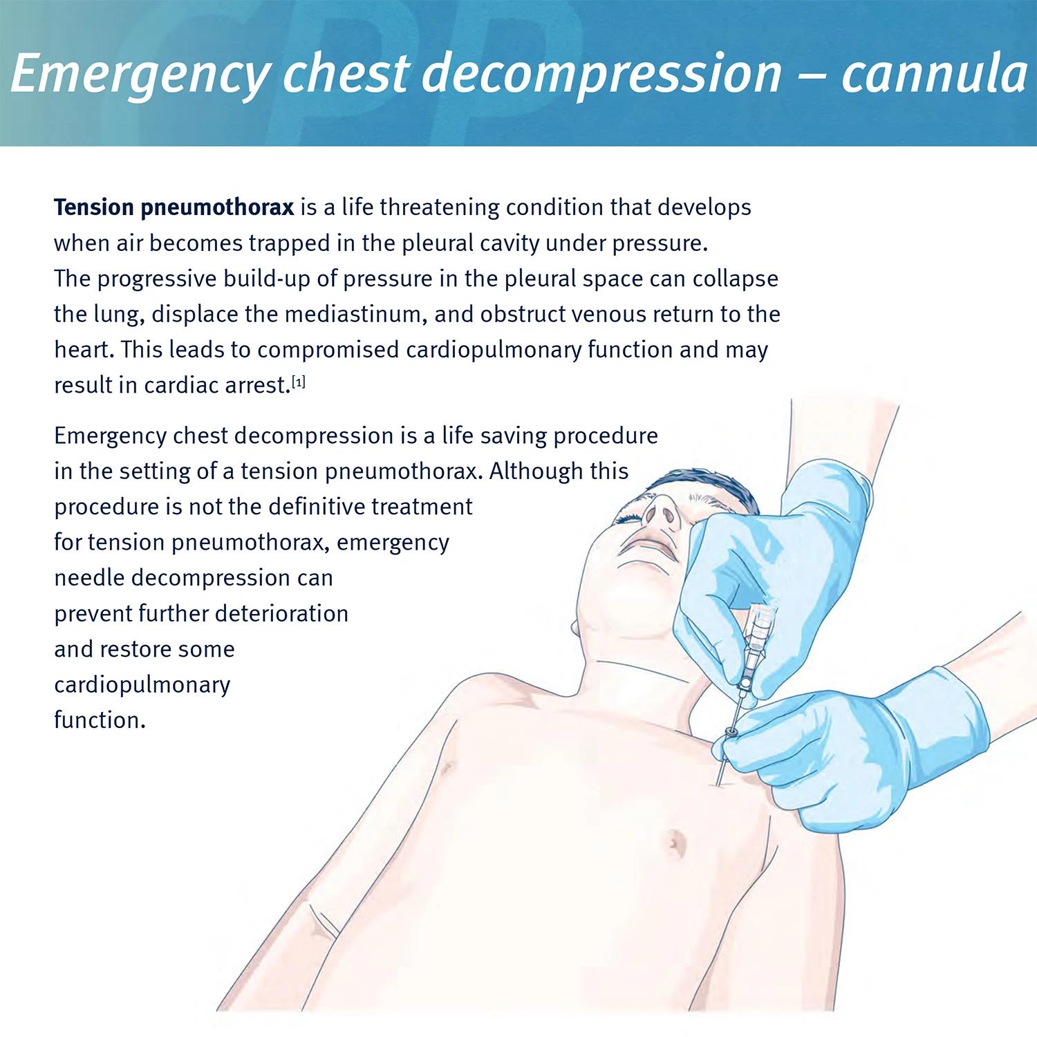 Sanke sauvetage pneumothorax aiguille traumatisme médical Ifak cathéter de poitrine aiguille 50g aig