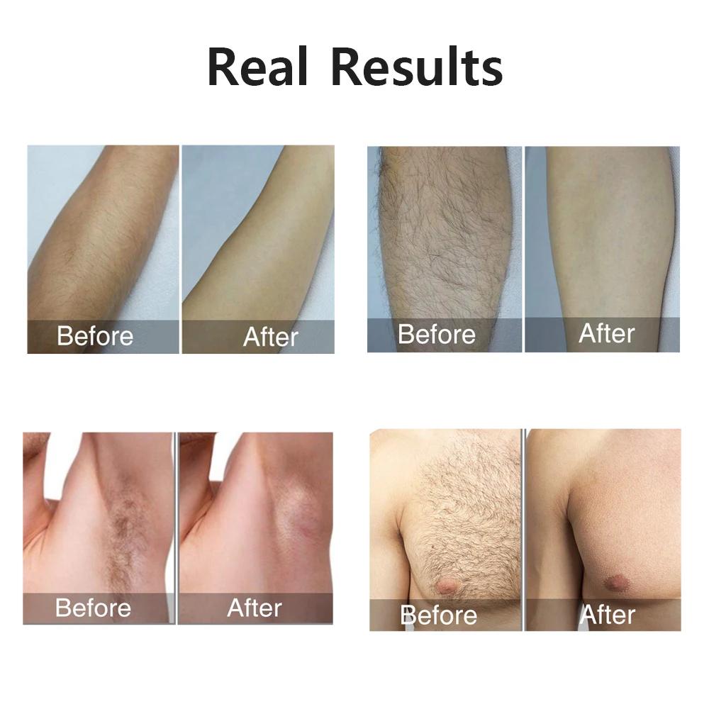 Depilador a laser ipl, remoção de pelos para mulheres, biquíni corporal, facial, 990000 flashes, per