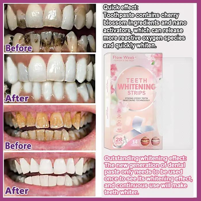 Flow-du-- Placages de protection dentaire, bandes de gel de placage dentaire, kit de soins bucco-den