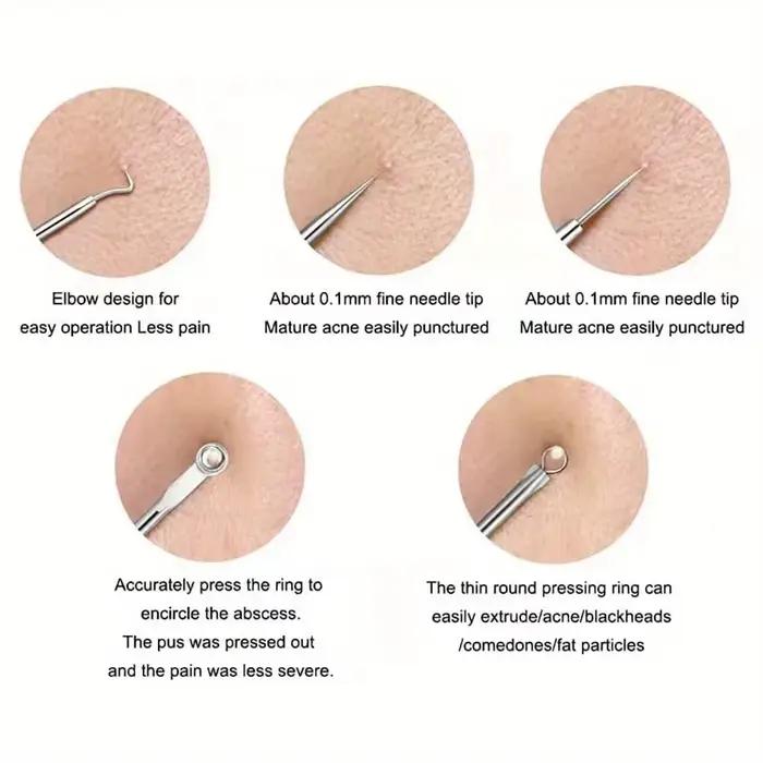 Kit d'extraction d'imperfections de boutons et d'acné, points noirs, aiguilles en acier inoxydable,